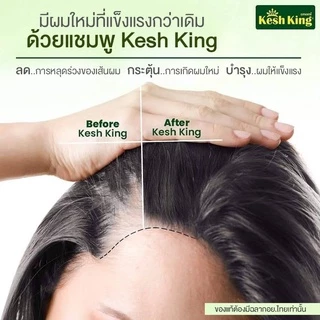 ซื้อในไลฟ์ 99 บาท ของแท้ แชมพู ลดผมร่วง ลดรังแค ขจัดปัญหาเส้นผม Kesh King Shampoo