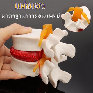 【กรุงเทพพร้อมส่ง】Human anatomy skeleton Spine Lumbar Intervertebral Disc Protrusion Model Magnification 2x Body Model