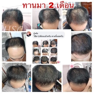 ซื้อ 1 แถม 1 HSC วิตามินเส้นผม HAIR SOLUTION CLINICวิตามินกระตุ้น บำรุงเส้นผมรากผมแข็งแรง ผมหนาขึ้น