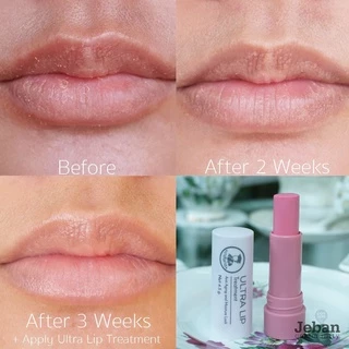 Ultra Lip Treatment 4.5 G. เภสัชกร แบบแท่ง อัลตราลิปทรีทเมนท์ ลิปมันเภสัช Ultralip
