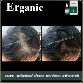 Erganic Hair Serum เซรั่มแก้ผมร่วง เพิ่มผมหนา ปลูกผม โดยแพทย์เฉพาะทางด้านเส้นผม มีหน่วยงานรัฐสนับสนุน คือ สสว. มธ.