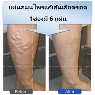 แผ่นแปะสมุนไพร Eelhoe varicose veins แก้เส้นเลือดขอดแผ่นแปะ 1 ซองมี  6แผ่น ของส่งจากไทย