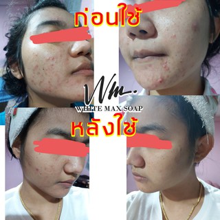 สบู่กำจัดสิวเสี้ยนให้ขาวเนียนปรับสภาพผิวให้ขาวกระจ่างใสสินค้าแท้นำเข้าจากเกาหลี White Max