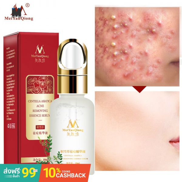 serum to remove acne marks