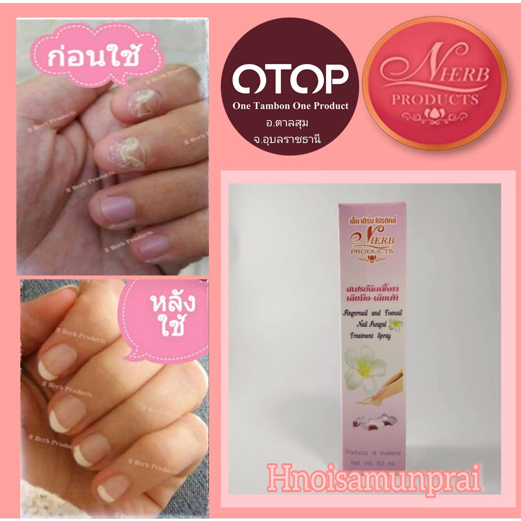 N HERB PRODUCTS (หน่อยสมุนไพร) Otopผลิตภัณฑ์ดูแลเล็บมือเล็บเท้าและจมูกเล็บ เล็บเป็นเชื้อรา ขวดสเปรย์