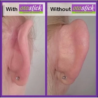 🔥แก้หูกาง🔥 OTOSTICK 2 แพ็ค แบบเนียนเป็นธรรมชาติสุด ยกกล่อง ล็อตใหม่ล่าสุด ฟรีแผ่นแอลกอฮอล์