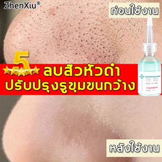 ZhenXiu เซรั่มบำรุงผิว 32ml ปรับปรุงรูขุมขนกว้าง สิวและให้ผิวชุ่มชื้นและเงางาม เซรั่มหน้าใส เซรั่มบำรุงผิวหน้า