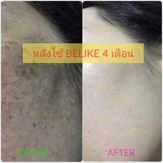 รับจากบริษัทโดยตรง 🌟 ครีม บีไล Belike บีไลค์ แก้ปัญหา สิว ฝ้า กระ หน้าหมองคล้ำ ขาว ไม่มีสารอันตราย