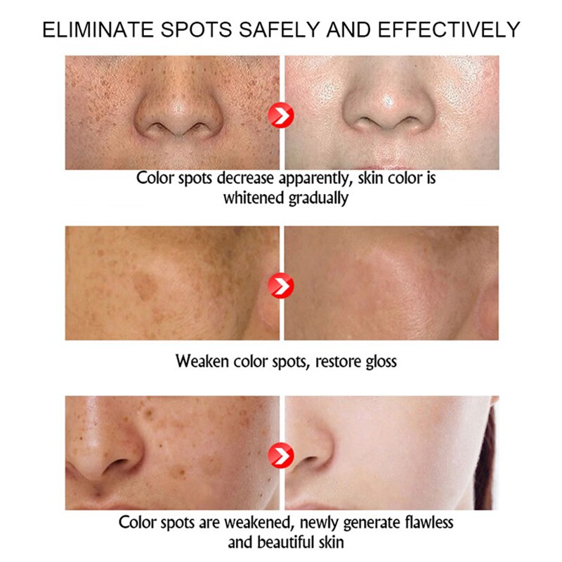 snmlpm freckle cream