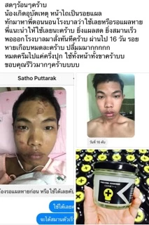 โปรตีนบัวหิมะ แก้ผดผื่น แก้รอยแตกลาย ใช้ได้ตั้งแต่เด็ก3ขวบ