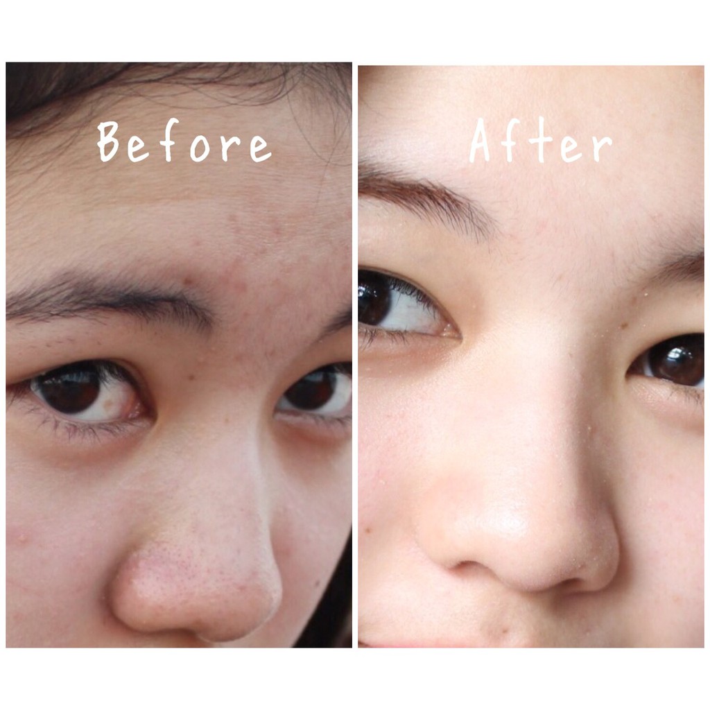 rojukiss acne serum