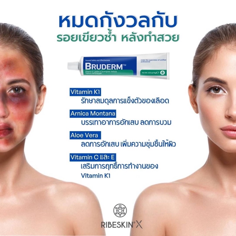 Bruderm  ครีมลดรอยช้ำ ลดบวมอันดับ 1 exp.08/27