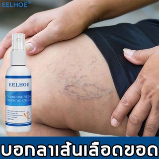 เชี่ยวชาญเรื่องเส้นเลือดขอด EELHOE เส้นเลือดขอด 30ml ปรับปรุงขาไส้เดือนบวมและความรุนแรง ครีมทาเส้นเลือดขอด ครีมทาเส้นขอด