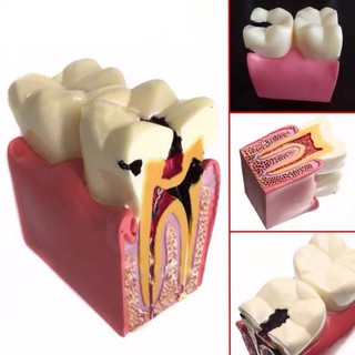 โมเดลกายวิภาคศาสตร์ฟัน 6 เท่า สําหรับการเรียนรู้ การแข่งขัน