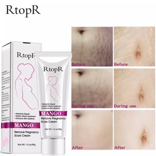 RtopR Mango Pregnancy Scar / Stretch Mark Removal Cream ครีมลดเลือนผิวแตกลายในครท้อง