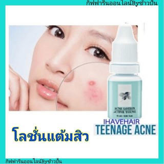 กิฟฟารีน โลชั่นแต้มสิว แอคทีฟ ยัง  Giffarine Acne Lotion Active Young บรรเทาอาการอักเสบ สิววัยรุ่น