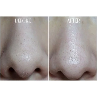 ส่งฟรี/แท้ ครีมลอกสิวเสี้ยน ลอกสิวเวียดนาม แพคเกจใหม่ ลอกสิวเสี้ยนขั้นเทพ ลอกสิว บอกลา สิวเสี้ยน สิวหัวดำ สิวอุดตัน