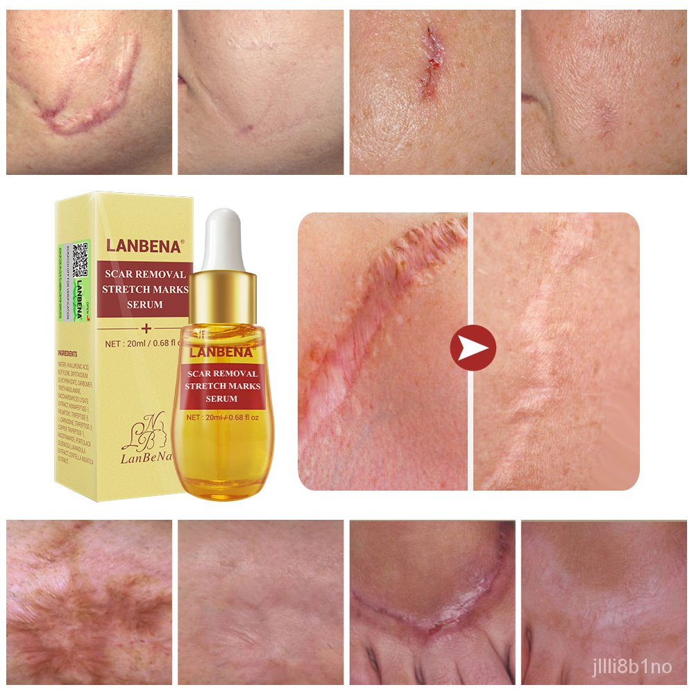 acne marks removal serum
