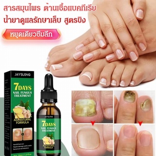 ดูแลมือ เท้า และเล็บ โลชั่นซ่อมแซมเชื้อราที่เล็บ น้ำยาดูแลรักษาเล็บ สูตรขิง