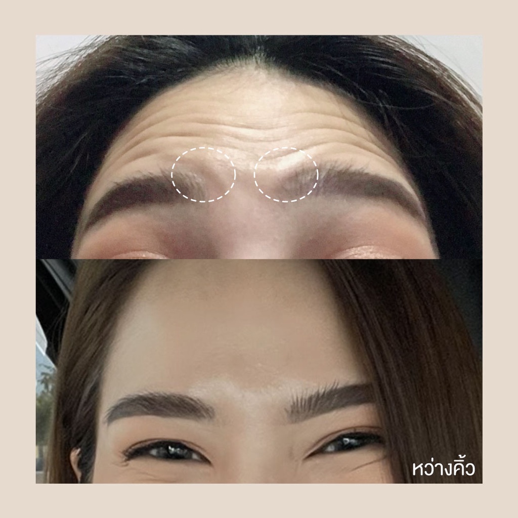 Botox (Nabota) Wrinkles or Jawline or Face Lift / ริ้วรอย หรือ กราม หรือ ลิฟหน้า โบท็อกเกาหลียี้ห้อเดียวที่ได้ US FDA
