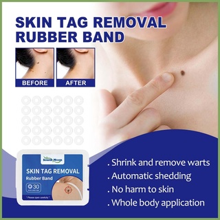 30pcs Skin Tags Remover Device Safe Micro Bands Mole Wart Remover Wart Rubber Rings Patch teith