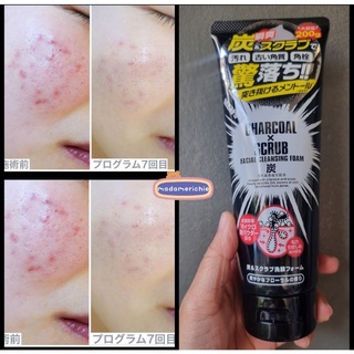 โฟมล้างหน้าญี่ปุ่น charcoal x scrub foam ลดสิวอุดตัน กระชับรูขุมขน ผิวกระจ่างใส ของแท้