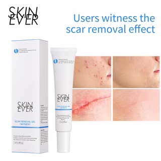 SKIN EVER Herbal Gel Acne Treatment Cream Repair Skin Scar Removal Pimple Mark Remove Scar Gel Fades Scars Face Care 30g