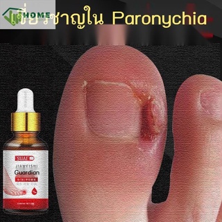 สิ่งประดิษฐ์ Paronychia รักษาเล็บคุด แดง บวม ปวด ของเหลวต้านเชื้อแบคทีเรียเป็นหนอง แก้เล็บเท้าโดยเฉพาะ