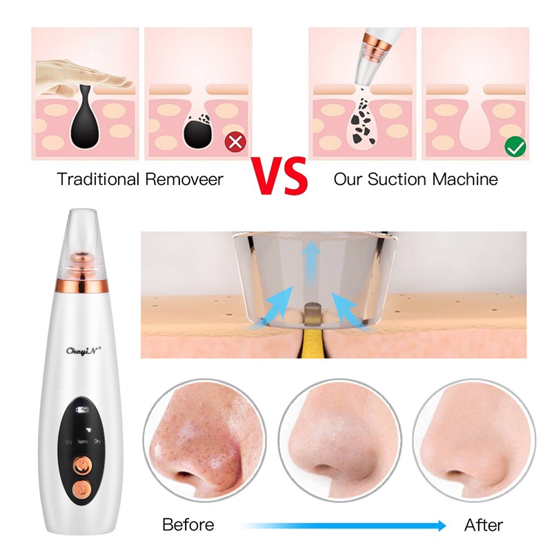 CkeyiN 6 Tips Electric Blackhead Remover Vacuum Suction Acne Comedo