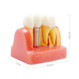 【ddydental】โมเดลฟันยาว 4 ชิ้น สําหรับสอนทันตกรรม