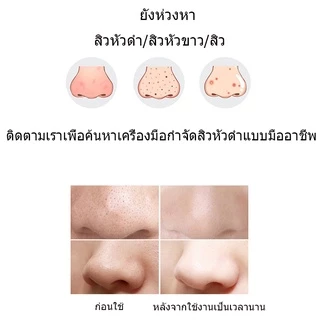 🔥 พร้อมส่ง 🔥เครื่องดูดสิว ที่ดูดสิวเสี้ยน สิวข้างจมูก ดูดสิวเสี้ยนอุดตันลบรอยจุดดำจากสิวเสี้ยนที่จมูก เครื่องดูดสิวไฟฟ้า