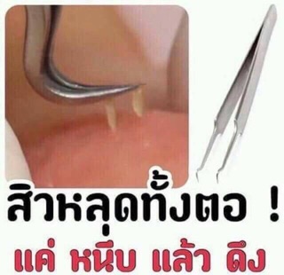 ที่กดสิว ที่หนีบสิว ที่คีบสิว กดสิว SERVICH