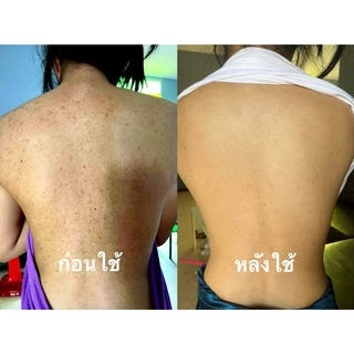สเปรย์รักษาสิวที่หลัง สิวหน้าอก สิวใบหน้า สูตรแพทย์แผนไทย สเปรย์รักษารอยดำหลัง สเปรย์ใบชา