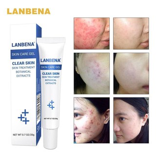 LANBENA ครีมรักษาสิว ช่วยลดรอยแผลที่เกิดจากสิวให้จางลง Acne Treatment Gel Acne Cleaning Cream