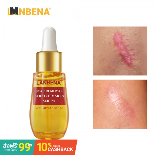 acne treatment essence cream