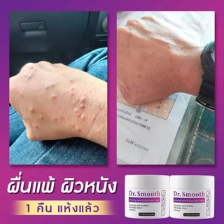 🔥แนะนำๆ🔥Dr.smooth ครีมทา ดูแลปัญหา ผด ผื่น ตุ่มแดง ตุ่มใส อาการคัน เรื้อรัง ยิ่งเกายิ่งลาม ลดรอยแผลจากการเกา 1 กระปุก