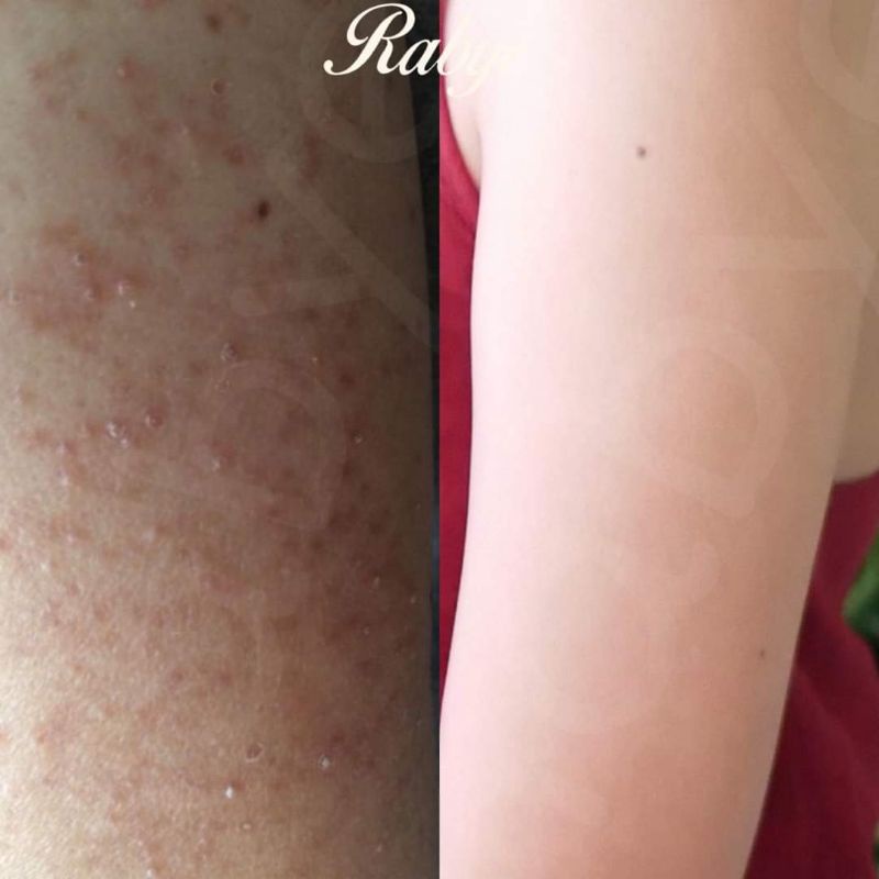 Rabye เซตพื้นฐานที่จำเป็นกับผิวที่มีปัญหา ขนคุด รอยดำ ผิวอักเสบแดง คัน ...