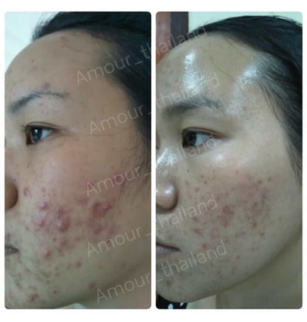 AMOUR Acne Lotion for acne ราคา ถูกที่สุด ดีลบีเคเค แกลเลอรีภาพที่ 5