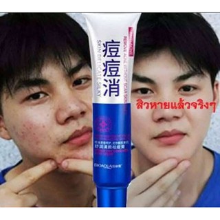 #86 Acne cream ครีมรักษาสิว ครีมแต้มสิว เจลรักษาสิว ครีมลบสิว ครีมรักษารอยสิวรอยแดง เครื่องสำอางสำหรับผู้ที่เป็นสิว