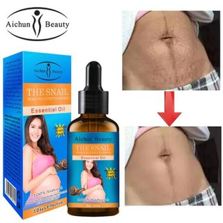 ลดริ้วรอยหลังคลอด หน้าท้องลาย ท้องเนียน  Aichun Stretch Marks Remover Essential Oil Skin Care Treatment Cream 30g