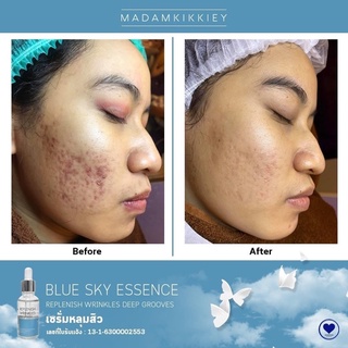 Blue Sky Serum(หลุมสิวตื้น รูขุมขนกระชับ)แพ็คเกจใหม่❄️