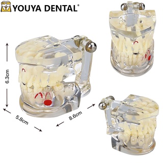 โมเดลฟันถาวร พร้อมฟันกวนใจ สําหรับนักเรียน การเรียนการสอนทางทันตกรรม
