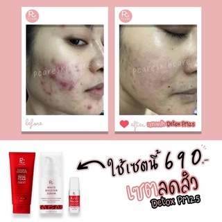 เซ็ทลดสิว ผิวแพ้ง่าย PCARE Clear Complet+PCARE Booster Serrum+PCARE Anti Acne Lotion