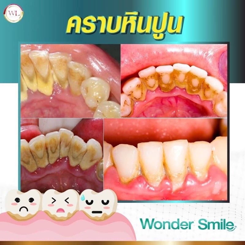 ยาสีฟันฟันขาว Wonder Smile