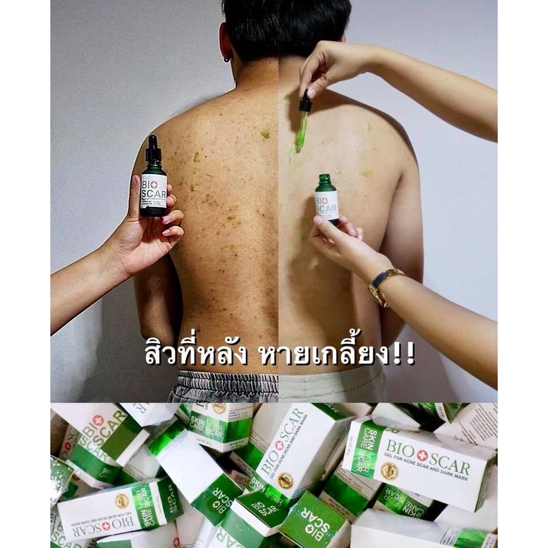 Bioscar ไบโอสการ์เจล ลบรอยแผลเป็น ขาลาย ตุ่ม รอยสิว น้ำเหลืองไม่ดี ผิวแพ้ง่ายใช้ได้ สูตรเข้มข้น สารสกัดจากธรรมชาติ thumbnail 7
