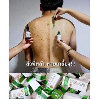 Bioscar ไบโอสการ์เจล ลบรอยแผลเป็น ขาลาย ตุ่ม รอยสิว น้ำเหลืองไม่ดี ผิวแพ้ง่ายใช้ได้ สูตรเข้มข้น สารสกัดจากธรรมชาติ