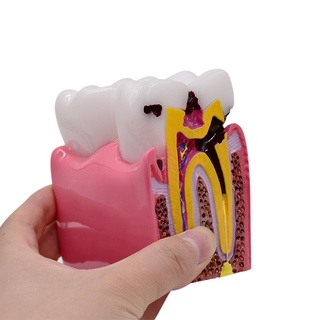 High Quality Dental Anatomy Education Teeth Model 6 Times Caries Comparation Study LW0S