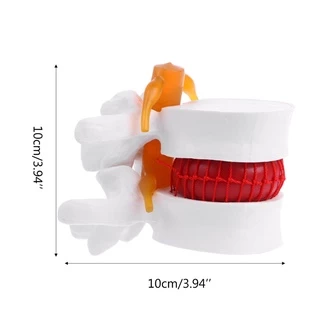 กายวิภาคของมนุษย์ Lumbar Disc Herniation Model การแพทย์ เรียนรู้ Aid Anatomy Instrume