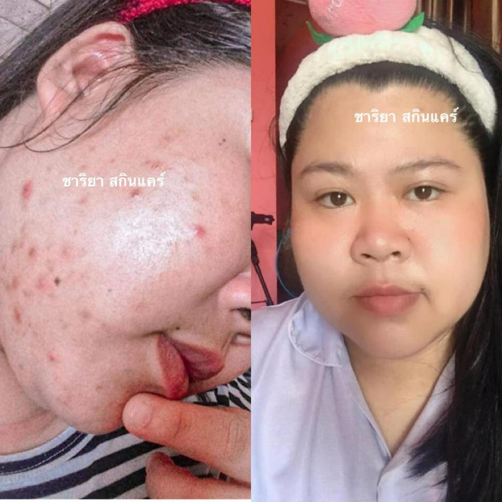 เจลล้างหน้าชาริยา ใบบัวบก ลดสิว ผิวแพ้ง่าย สูตรอ่อนโยน 100ml แถมฟรี สบู่น้ำผึ้ง (CHARIYA Centella Gel Face Wash) - รูปที่ 7