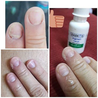 สมุนไพรทา เล็บเชื้อรา เล็บติดเชื้อ จากการ กัดเล็บ สีเขียว  1หลอด14cc Nail Polish Nail Fungus Cause